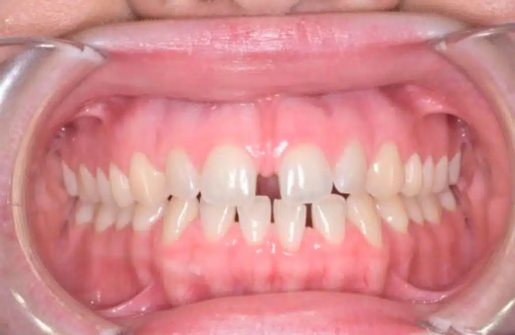 ortodoncia invisible cem valderas dentistas alcorcon antes caso real