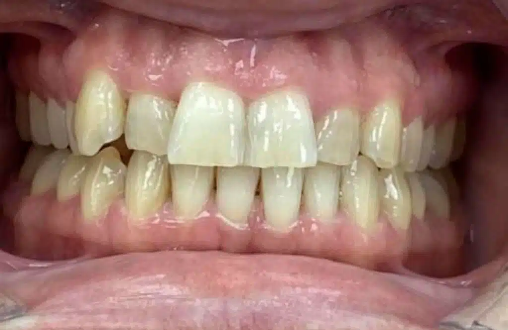 ortodoncia-invisible-cem-valderas-dentistas-alcorcon-antes-caso-real-4
