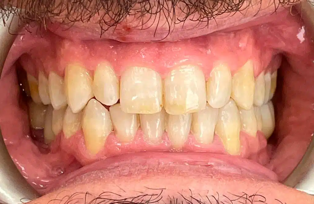 ortodoncia invisible cem valderas dentistas alcorcon depues caso real paciente