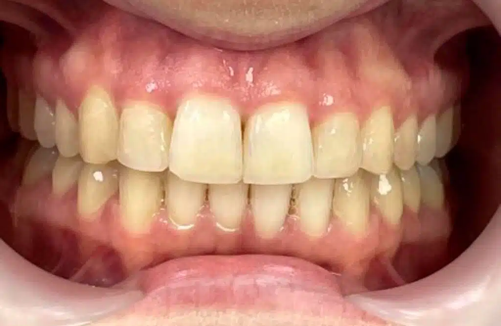 ortodoncia-invisible-cem-valderas-dentistas-alcorcon-depues-caso-real-paciente-4