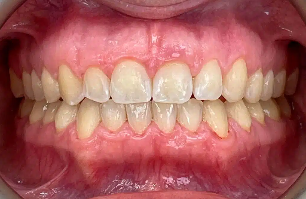 ortodoncia invisible cem valderas dentistas alcorcon despues caso real