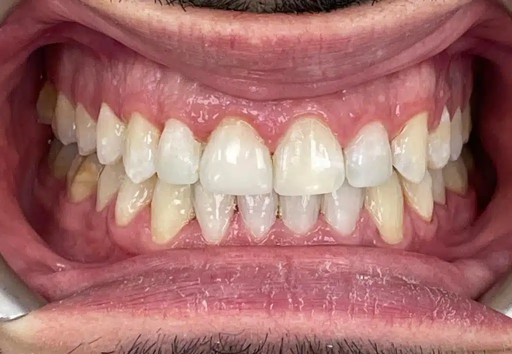 ortodoncia-invisible-cem-valderas-dentistas-alcorcon-despues-caso-real-paciente-mejores-dentistas-sur-madrid